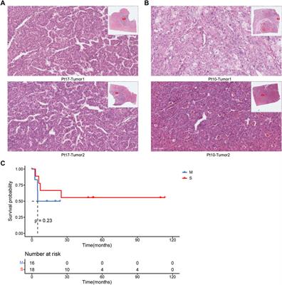 Cross Analysis of Genomic-Pathologic Features on Multiple Primary Hepatocellular Carcinoma